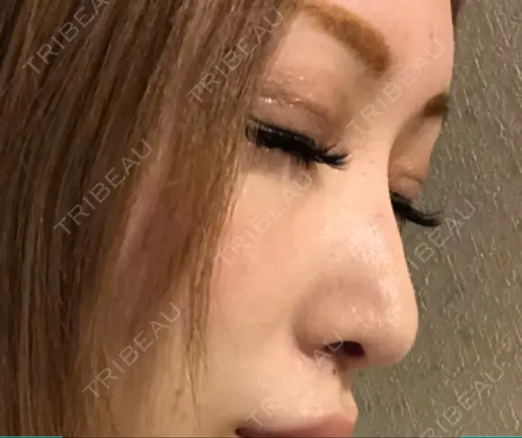 鼻尖形成（切開） 銀座マイアミ美容外科 DAY 21 メイン用
