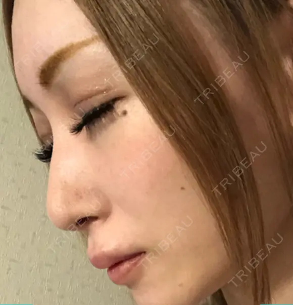 鼻尖形成（切開） 銀座マイアミ美容外科 DAY 21 メイン用