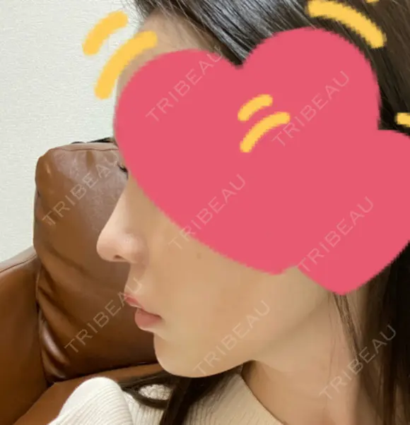 小鼻縮小（切開） / 鼻翼基部形成（貴族手術） 新宿ラクル美容外科クリニック 新宿院 AFTER メイン用