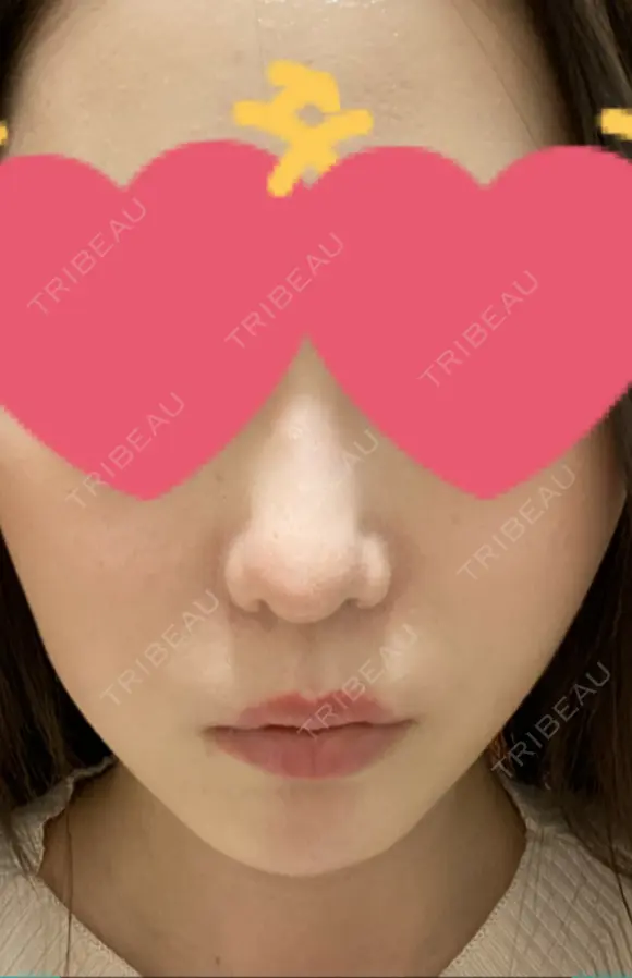 小鼻縮小（切開） / 鼻翼基部形成（貴族手術） 新宿ラクル美容外科クリニック 新宿院 DAY 104 メイン用