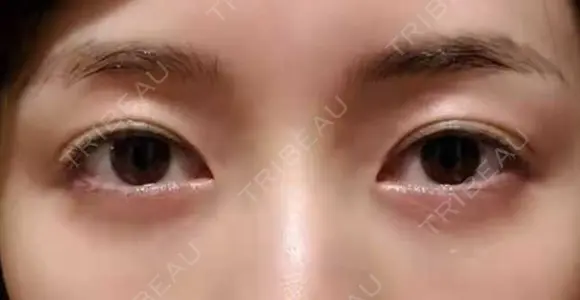 クマ治療 APOLLO BEAUTY CLINIC DAY 20 メイン用