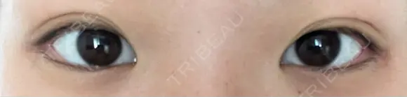 二重埋没 TCB東京中央美容外科 仙台駅前院 AFTER メイン用