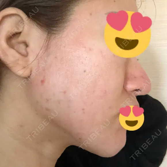 ピーリング（ニキビ・毛穴） / ダーマペン 表参道スキンクリニック 名古屋院（DAILY SKIN CLINIC提携院） DAY 11 メイン用