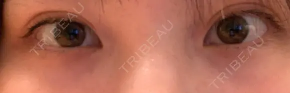 下まぶたの脂肪取り 品川美容外科 仙台院 DAY 18 メイン用