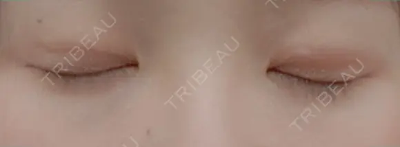 二重埋没 湘南美容クリニック 藤沢院 DAY 14 メイン用