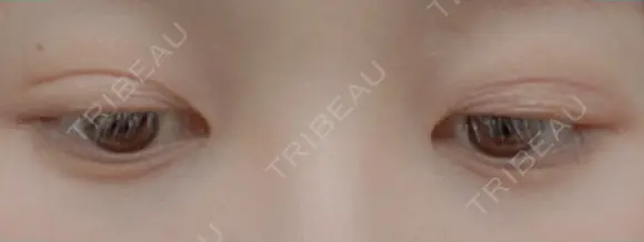 二重埋没 湘南美容クリニック 藤沢院 DAY 14 メイン用