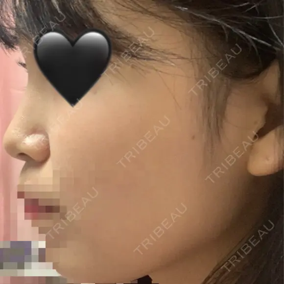 鼻尖形成（切開） / 鼻中隔延長（切開） / 軟骨移植 / その他（鼻） KAUNIS CLINIC（カウニスクリニック） DAY 35 メイン用