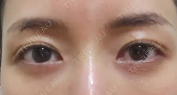 クマ治療 APOLLO BEAUTY CLINIC DAY 25 メイン用