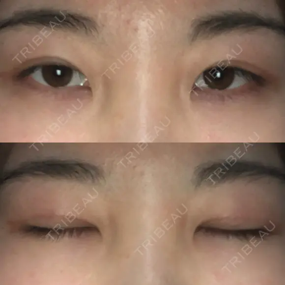 二重切開 / 眼瞼下垂（切開） ブリスクリニック形成外科・美容外科・美容皮膚科 福岡 DAY 59 メイン用