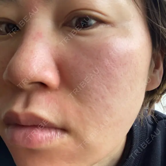 ダーマペン / 毛穴洗浄（ハイドラフェイシャルなど） B-LINE CLINIC 池袋院 DAY 1 メイン用