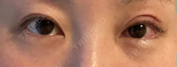 眼瞼下垂（切開） くさのたろうクリニック AFTER メイン用