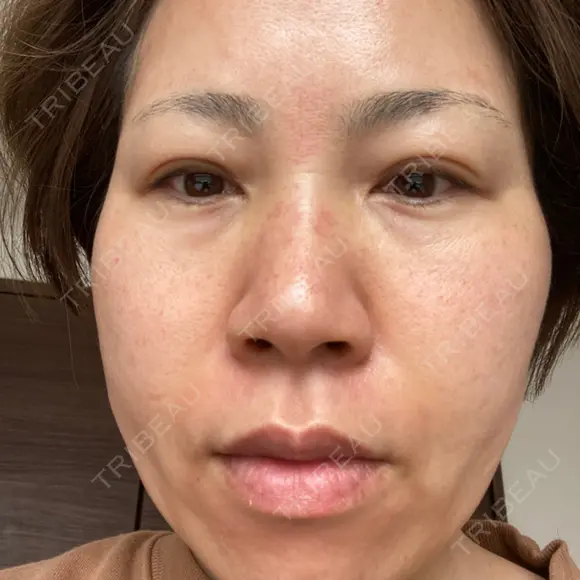 ダーマペン / 毛穴洗浄（ハイドラフェイシャルなど） B-LINE CLINIC 池袋院 DAY 2 メイン用
