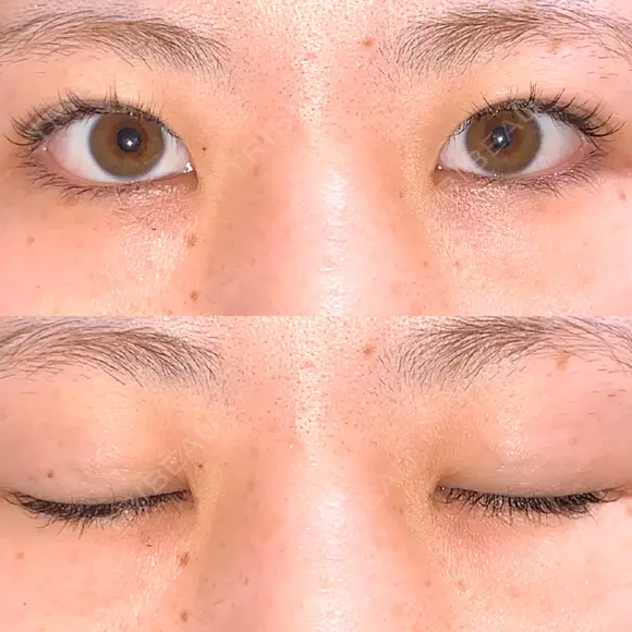 二重埋没 R.O.clinic DAY 189 メイン用