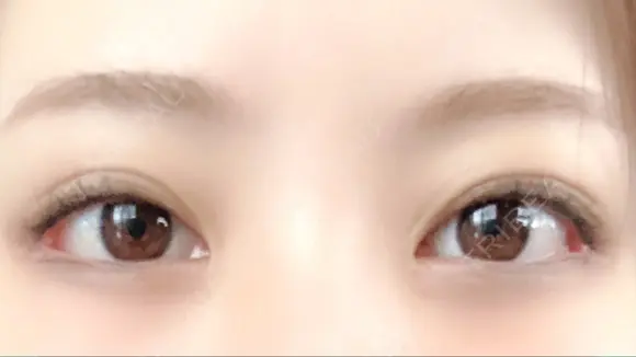 目頭切開 / 目尻切開 FROM B整形外科 (旧バウム整形外科) AFTER メイン用