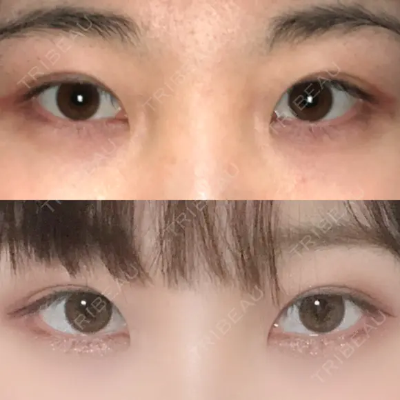 二重切開 / 眼瞼下垂（切開） ブリスクリニック形成外科・美容外科・美容皮膚科 福岡 DAY 62 メイン用