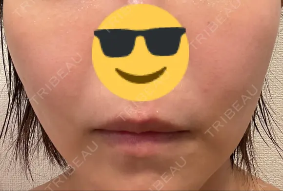 シミ取りレーザー PICO BEAUTY CLINIC DAY 1 メイン用