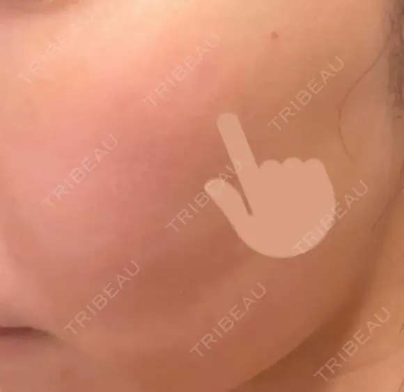 シミ取りレーザー PICO BEAUTY CLINIC DAY 1 メイン用