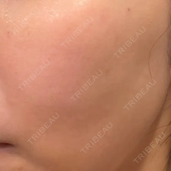 シミ取りレーザー PICO BEAUTY CLINIC DAY 1 メイン用