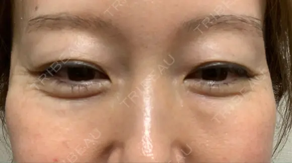 クマ治療 / 下まぶたたるみ取り / 下まぶたの脂肪取り セオリークリニック DAY 28 メイン用