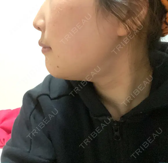 セットバック カトレア歯科・美容クリニック DAY 10 メイン用