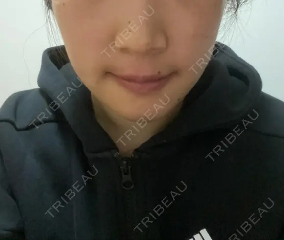 セットバック カトレア歯科・美容クリニック DAY 10 メイン用