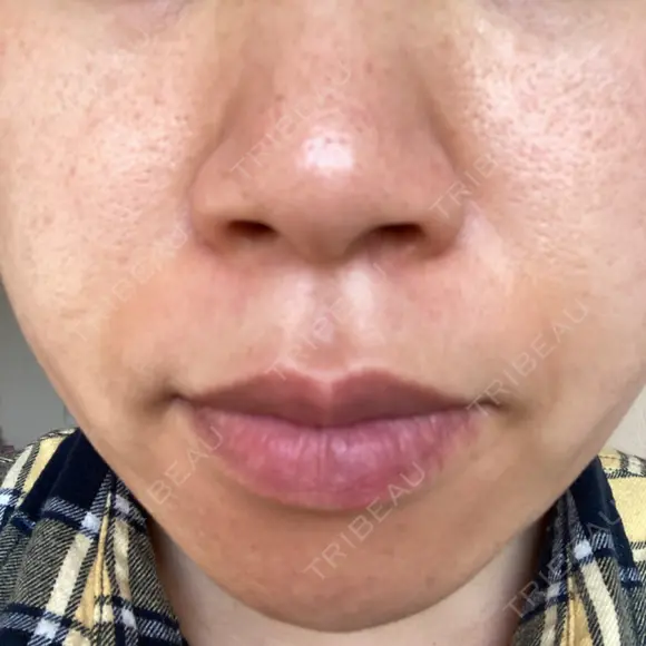ダーマペン / 毛穴洗浄（ハイドラフェイシャルなど） B-LINE CLINIC 池袋院 AFTER メイン用