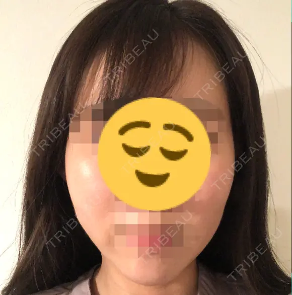 脂肪注入（輪郭） 湘南美容クリニック 新潟院 DAY 14 メイン用