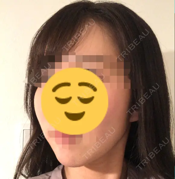 脂肪注入（輪郭） 湘南美容クリニック 新潟院 DAY 14 メイン用