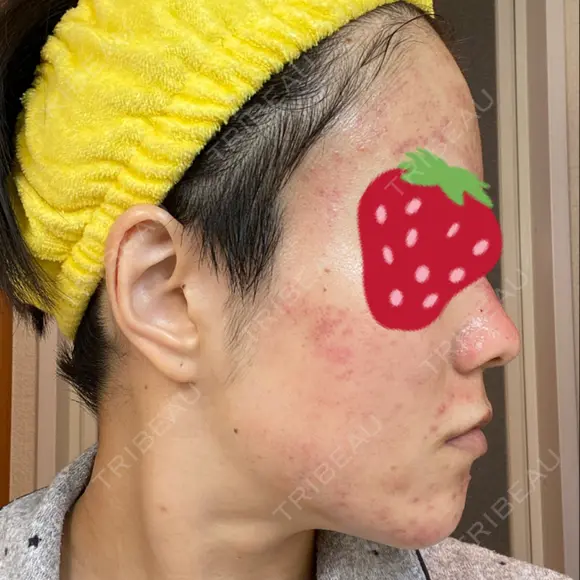 ダーマペン AURORA CLINIC（オーロラクリニック）新宿院 DAY 2 メイン用