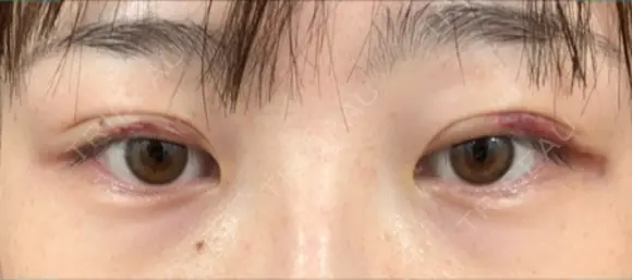 二重埋没 リオラビューティークリニック 柏院 DAY 3 メイン用