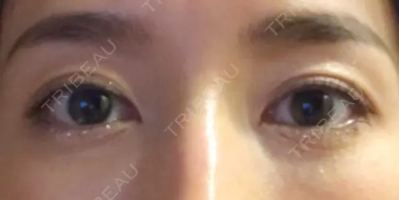 クマ治療 APOLLO BEAUTY CLINIC AFTER メイン用