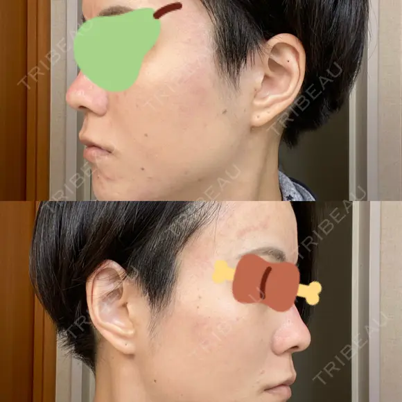 ダーマペン AURORA CLINIC（オーロラクリニック）新宿院 DAY 3 メイン用