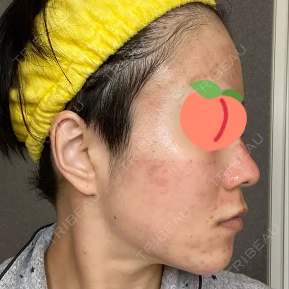 ダーマペン AURORA CLINIC（オーロラクリニック）新宿院 DAY 3 メイン用