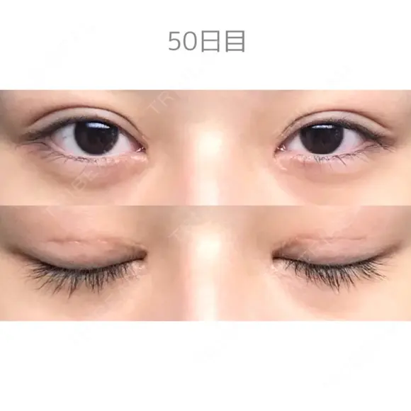 二重切開 / 目頭切開 / 上まぶたたるみ取り サラ美容外科 DAY 50 メイン用