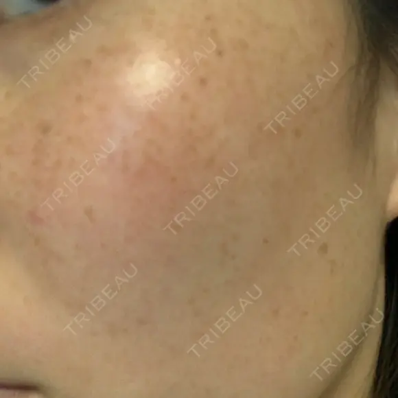 美肌レーザー / シミ取りレーザー たかはし形成外科･美容外科  DAY 7 メイン用