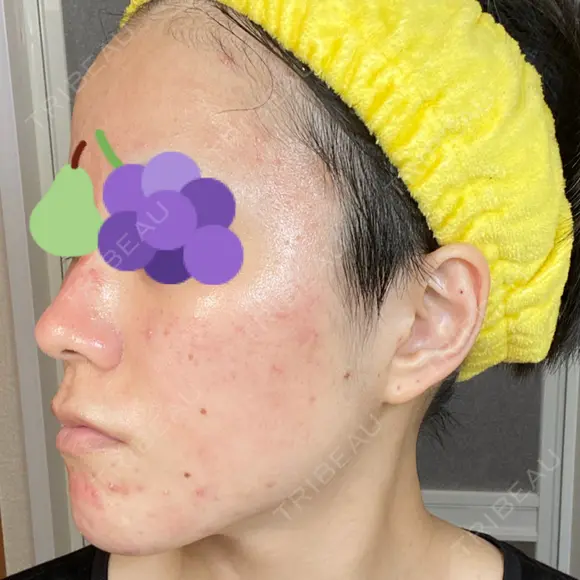 ダーマペン AURORA CLINIC（オーロラクリニック）新宿院 DAY 4 メイン用