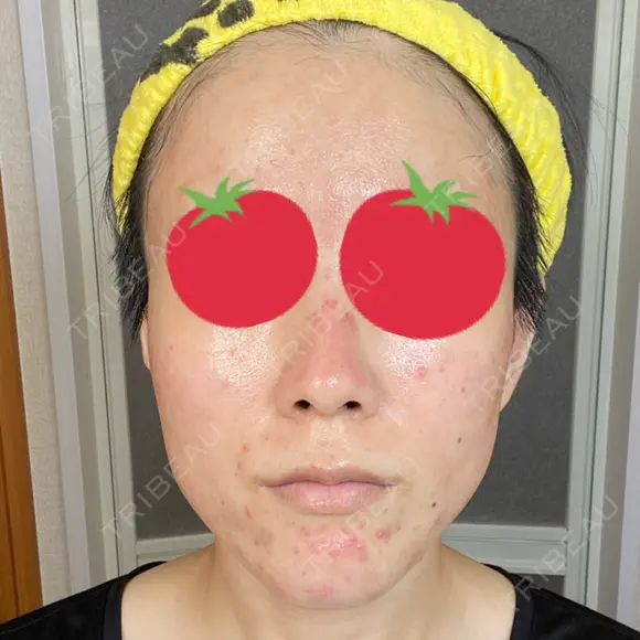 ダーマペン AURORA CLINIC（オーロラクリニック）新宿院 DAY 4 メイン用