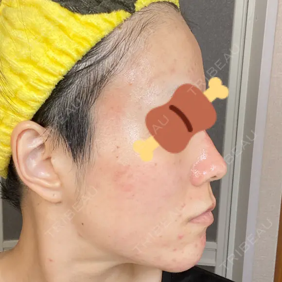 ダーマペン AURORA CLINIC（オーロラクリニック）新宿院 DAY 4 メイン用