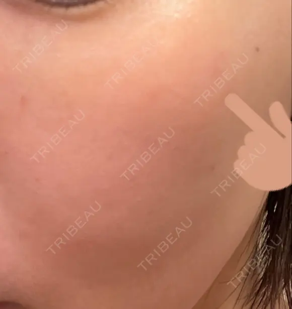 シミ取りレーザー PICO BEAUTY CLINIC DAY 7 メイン用