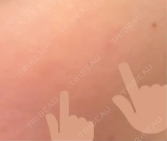 シミ取りレーザー PICO BEAUTY CLINIC DAY 7 メイン用