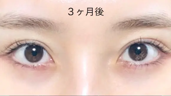 二重切開 / 上まぶたたるみ取り R.O.clinic DAY 90 メイン用