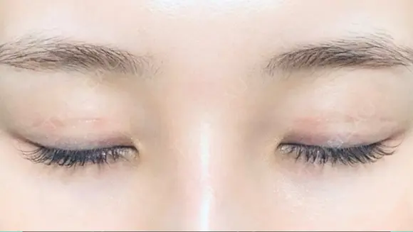 二重切開 / 上まぶたたるみ取り R.O.clinic DAY 90 メイン用