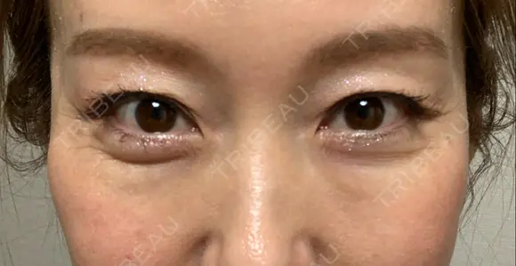 クマ治療 / 下まぶたたるみ取り / 下まぶたの脂肪取り セオリークリニック DAY 31 メイン用