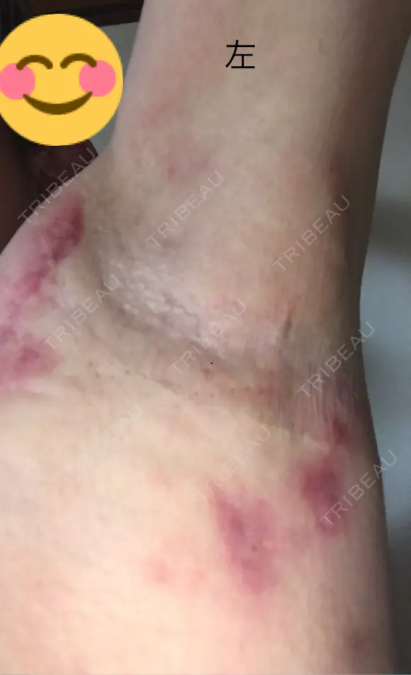 その他（肌） 湘南美容クリニック 奈良院 DAY 1 メイン用
