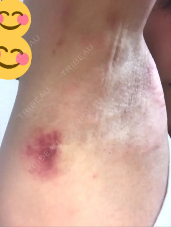 その他（肌） 湘南美容クリニック 奈良院 DAY 2 メイン用