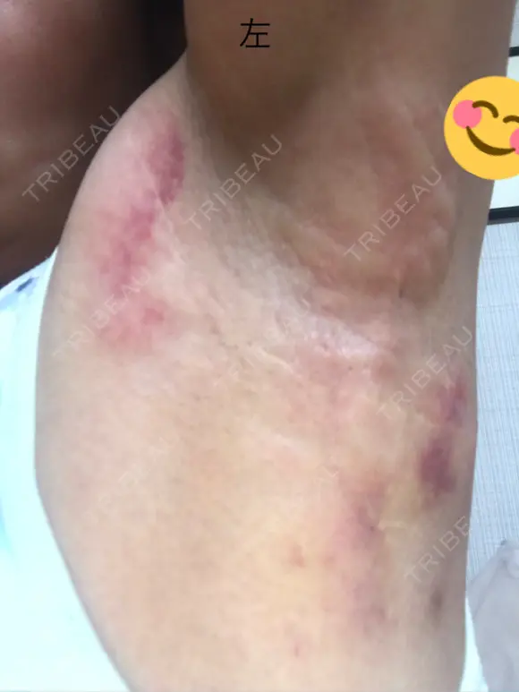 その他（肌） 湘南美容クリニック 奈良院 DAY 2 メイン用