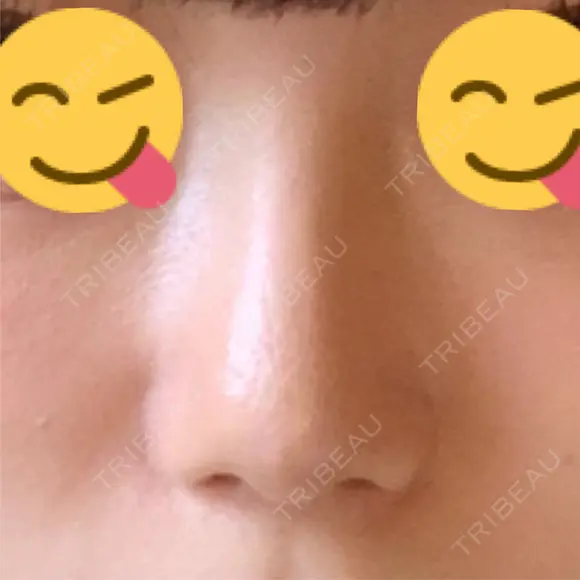 小鼻縮小（切開） Taide Suenaga Clinic（タイデスエナガクリニック） DAY 70 メイン用