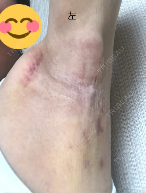 その他（肌） 湘南美容クリニック 奈良院 DAY 3 メイン用