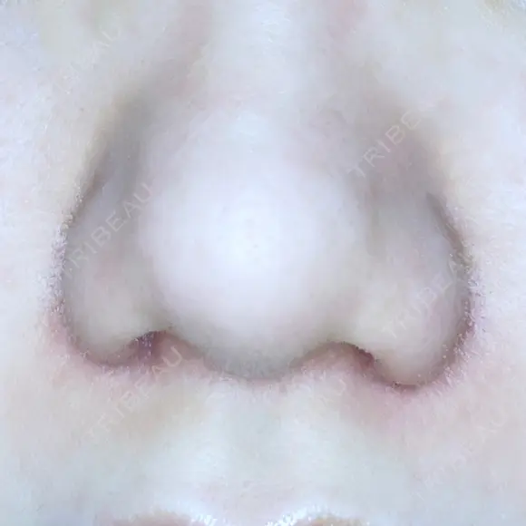 小鼻縮小（切開） ながしまクリニック DAY 12 メイン用