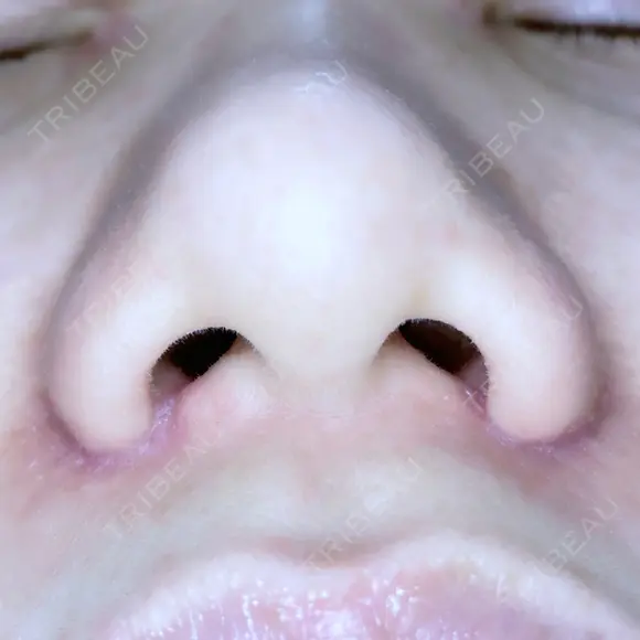 小鼻縮小（切開） ながしまクリニック DAY 12 メイン用